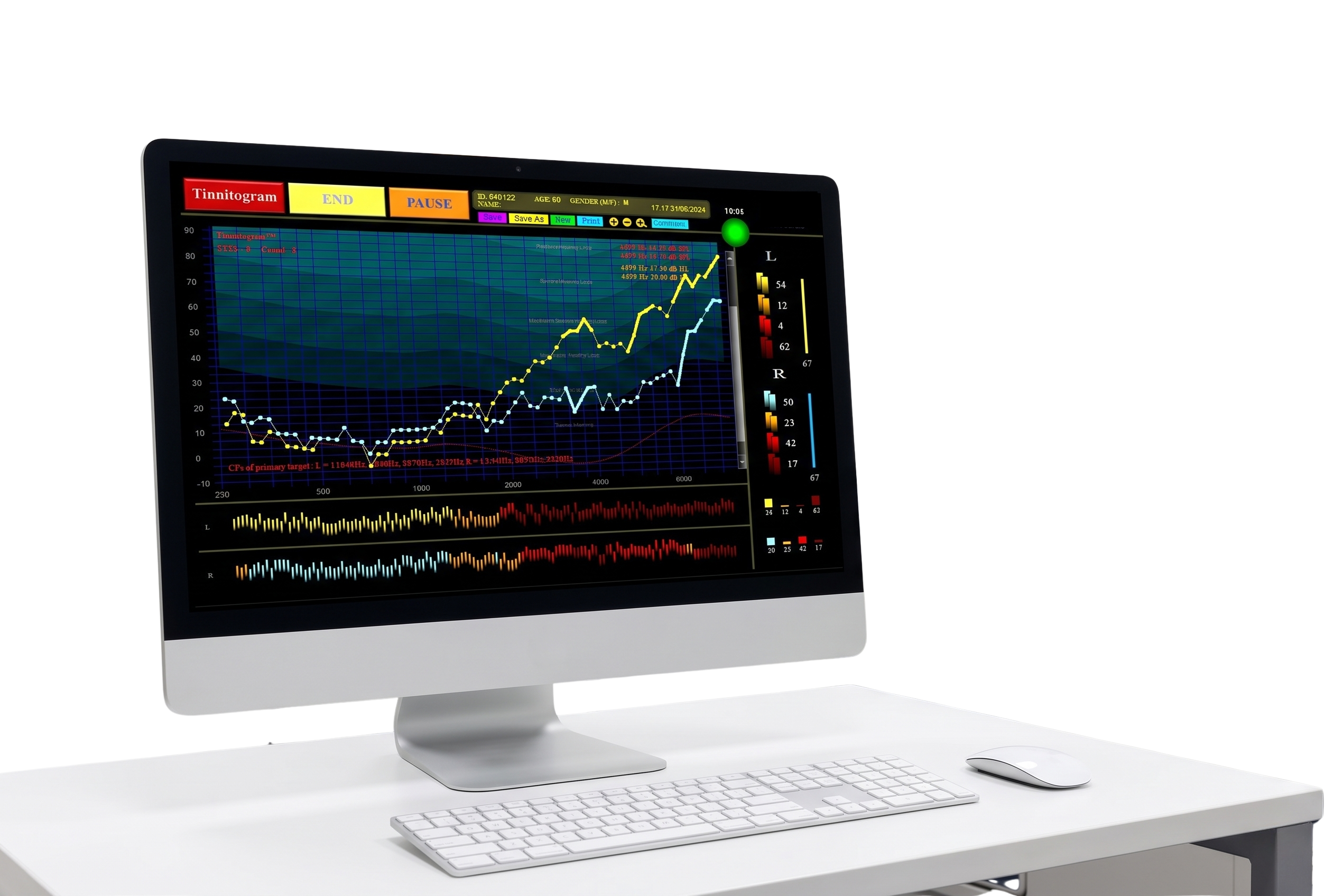 Tinnitogram software displaying a 67-band hearing threshold analysis on a clinic monitor